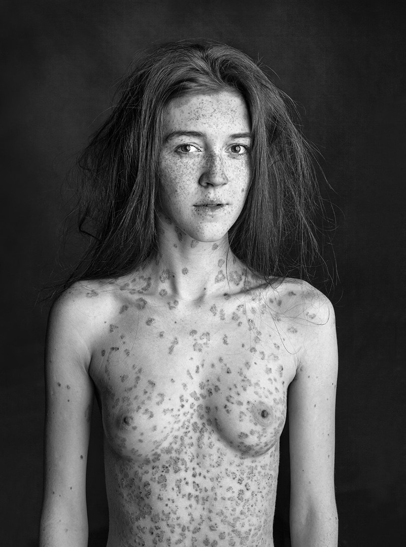 Vitiligo women nude