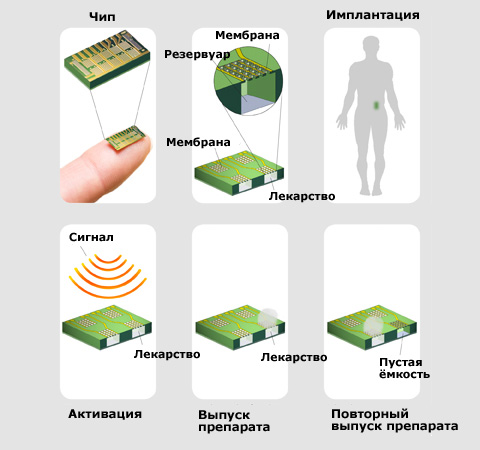 Чипы имплантов. Имплантация микрочипов.