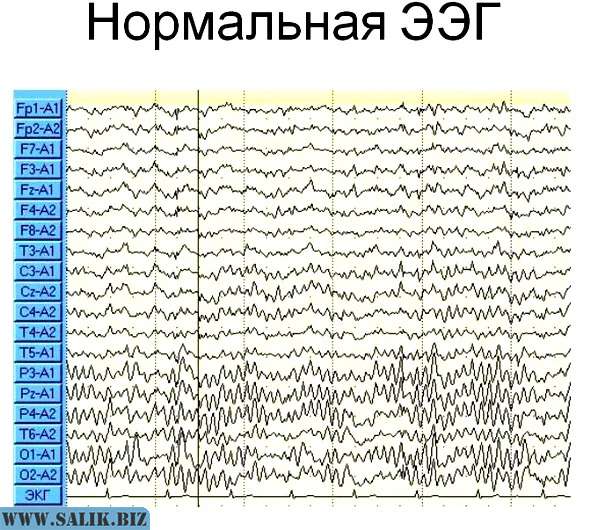Ээг рязань. Электроэнцефалография головного мозга (ЭЭГ). Энцефалограмма головного мозга ребенку. Нормальная диаграмма ЭЭГ. Электроэнцефалография или ЭЭГ.
